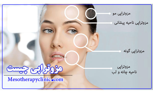 مزوتراپی